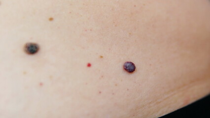 Red moles and dots on the female body. Large mole on stomach. Melanoma, hemangiomas, lipoma, atheroma, malignant and benign moles. Oncology. The medicine. Close-up photo, blurry. - obrazy, fototapety, plakaty