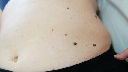 Red moles and dots on the female body. Large mole on stomach. Melanoma, hemangiomas, lipoma, atheroma, malignant and benign moles. Oncology. The medicine. Close-up photo, blurry.