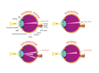 Eye defects. Normal vision, Hyperopia, Myopia. - obrazy, fototapety, plakaty