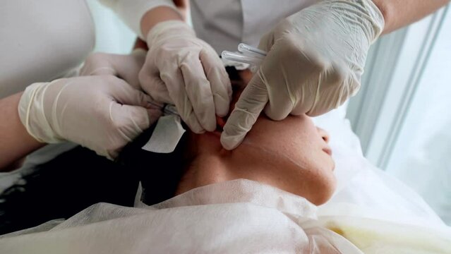 modern plastic surgery for rejuvenating and lifting of facial skin, surgeon is installing strings