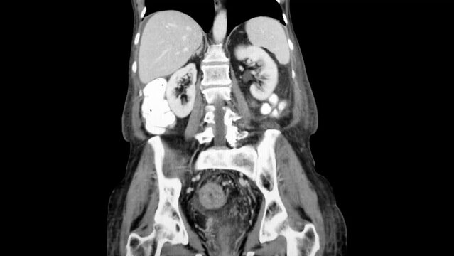 CT abdomen and pelvis- severe Clostridium difficile colitis