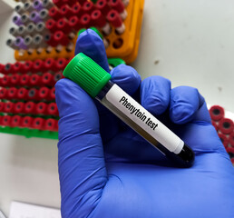 Blood sample for Phenytoin test, therapeutic drug, to maintain a therapeutic level and diagnose...