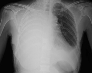 Pleural effusion in chest x-ray