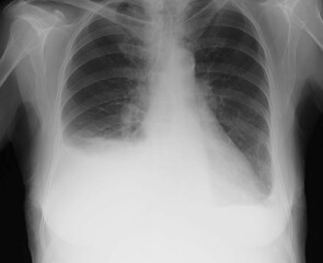 Pleural effusion in chest x-ray
