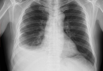 Pleural effusion in chest x-ray