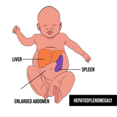 Hepatosplenomegaly, or enlargement of the liver and spleen, can occur from an inherited problem in which the liver cannot process glucocerebroside. - obrazy, fototapety, plakaty