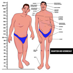Gigantism and acromegaly are syndromes characterized by excessive secretion of growth hormone. - obrazy, fototapety, plakaty