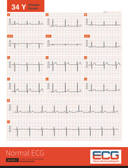 Normal electrocardiogram of a 34 year old Chinese healthy woman.The rhythm was sinus rhythm without other abnormal ECG changes.