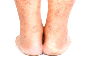 Itchy skin lesions from allergies, skin women