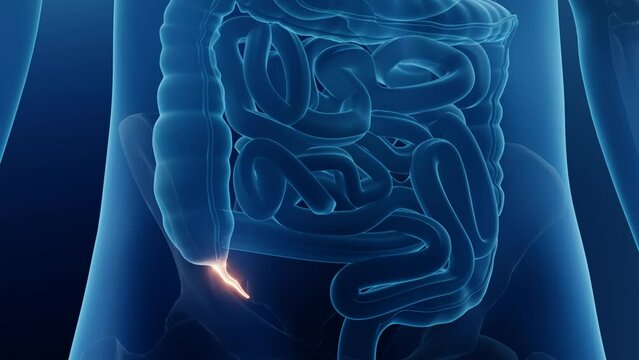 Appendix in human body close up, Appendicitis conceptual animation