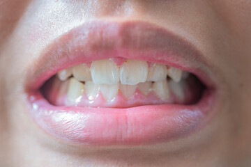 The teeth and gums are deformed and unattractive.