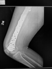 Right femur fracture radiograph - ORIF hardware in place