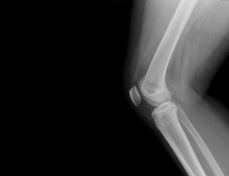 A photo of plain radiograph on dark background in hospital. The film use for diagnosis the illness of patient.Medical concept.Film lateral knee in patient with knee pain.Osteoarthritis of joint.