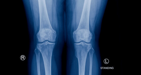 A photo of plain radiograph on dark background in hospital. The film use for diagnosis the illness of patient.Medical concept.Film both knee in patient with knee pain.Osteoarthritis of joint.