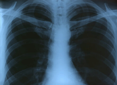 Medical X-Ray Image Of Human Chest MRI for diagnosis of diseases