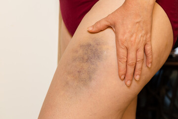 Giant bruise on a woman's thigh