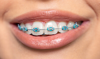 Closeup cropped shot, woman with dental braces 