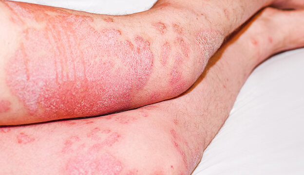 Acute psoriasis, severe reddening of the skin,an autoimmune,incurable dermatological skin disease.Large inflamed,scaly rash on man's legs.Red spots on the skin. Joints affected by psoriatic arthritis.
