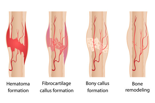 Stages of healing of bone fractures.