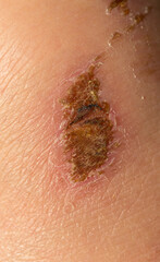 A wound on the body. Skin regeneration. Limb injury. Scratched knee.