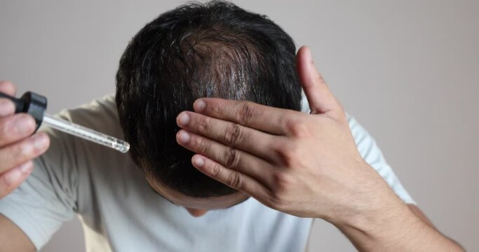man using minoxidil on bald scalp to treat male pattern hair loss or androgenic alopecia