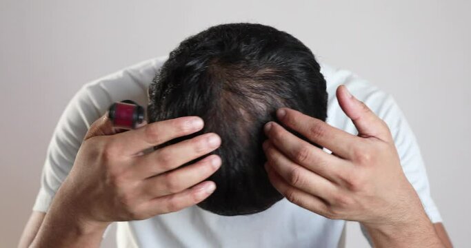 collagen induction therapy, Using dermaroller on bald area improve hair regrowth.