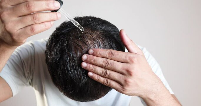 minoxidil, hair serum, Man with a dropper apply essential hair oil on the bald area for hair growth in white background.