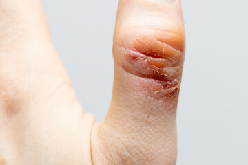 Chemical burn of a thumb finger. Household burn. An open deep wound. Damaged epidermis. Regeneration process. Close up view.