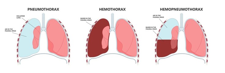 Lung cancer collapse chest pain drain rib bleb blunt insert tube fluid care disease cystic surgery oxygen blood triangle of safety suction pleurisy bleeding pus failure edema placement Disease Therapy