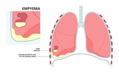 Lung cancer collapse chest pain drain rib bleb blunt insert tube fluid care disease cystic surgery oxygen blood triangle of safety suction pleurisy bleeding pus failure edema placement Disease Therapy