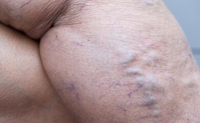 An elderly woman's hand touches her sick leg with vein thrombosis, varicose veins.