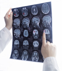 Epileptologist examines patient MRI and electroencephalogram. Concept treating epilepsy and helping...