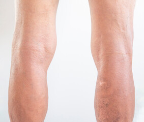 Leg and knee of an old man with synovial problems on a white background