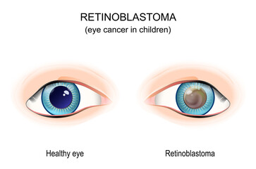 Retinoblastoma. eye cancer