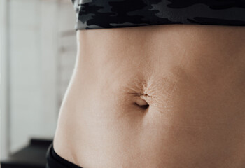 Skin. Abdomen of woman after the child birth by Cesarean section. Stretch marks after pregnancy. Navel hernia. White line diastasis. Close-up. Lymph flow violation and fluid stagnation