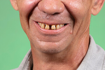 Part of the face with ugly yellow and sparse teeth. Dental problems of anterior teeth in an elderly person.Smiling mouth of a man with crooked yellow teeth close-up