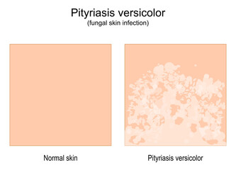 Pityriasis versicolor. fungal skin infection. tinea versicolor.
