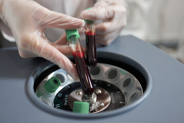 Platelet-Rich plasma preparation. Plasma in syringe. Centrifuge.
