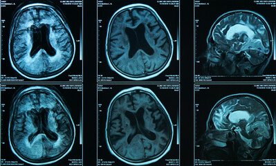 A snapshot of an elderly person's brain scan on magnetic resonance imaging MRI film, for...