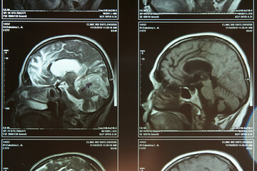 A fragment of an image of an elderly person's brain scan on magnetic resonance imaging MRI film for...