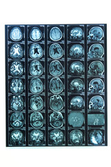 A snapshot of an elderly person's brain scan on magnetic resonance imaging MRI film, for...