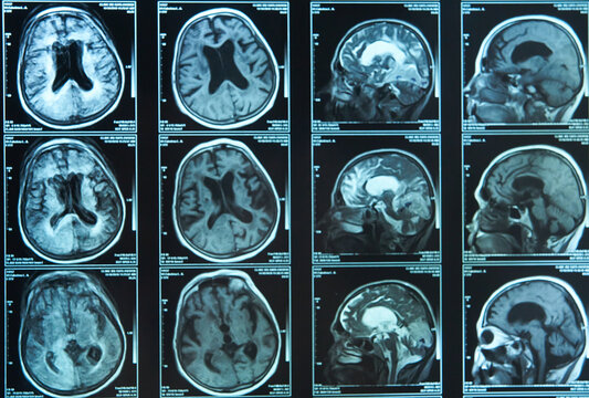 A snapshot of an elderly person's brain scan on magnetic resonance imaging MRI film, for neurological medical diagnosis of brain diseases