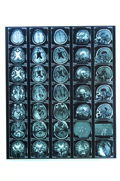 A snapshot of an elderly person's brain scan on magnetic resonance imaging MRI film, for neurological medical diagnosis of brain diseases