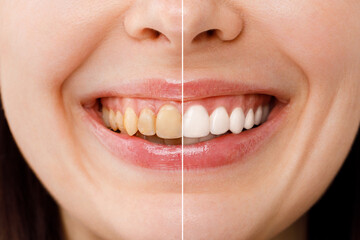 woman teeth before and after whitening. Over white background. Dental clinic patient. Image symbolizes oral care dentistry, stomatology.