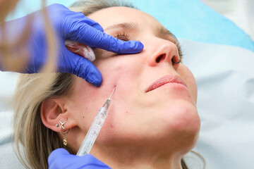 facial lifting with hyaluronic acid applied with a cannula