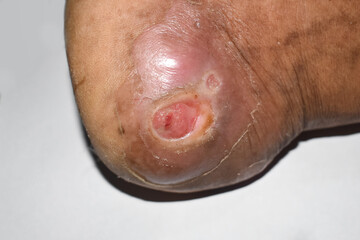 Diabetes foot ulcer in foot of Asian patient. - obrazy, fototapety, plakaty