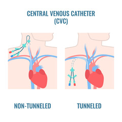 Tunneled and non-tunneled central venous catheters placed in the jugular and subclavian veins. CVC access device placement types. Medical vector illustration. - obrazy, fototapety, plakaty