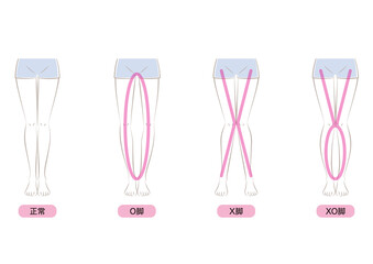 O脚・X脚・XO脚