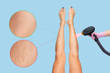 Woman lifted her slim legs. Cosmetologist holding a laser equipment. Two area with results before and after hair removal procedure. Concept of epilation and photoepilation