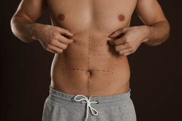 Fototapeta na wymiar Fit man with marks on body against dark brown background, closeup. Weight loss surgery